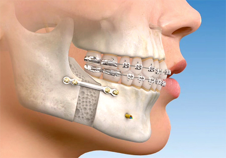 Cirurgia ortognática: estética, saúde e bem-estar